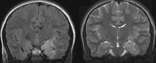 Structural Neuroimaging | Neupsy Key