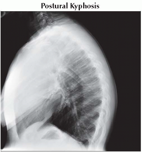 Kyphosis | Neupsy Key