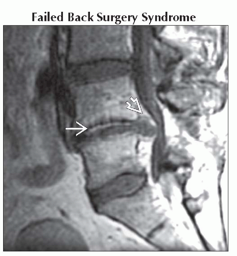 Chronic Back Pain/Radiculopathy, Post-Operative | Neupsy Key