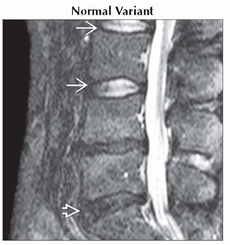 intervertebral-disc-t2-hyperintense-neupsy-key