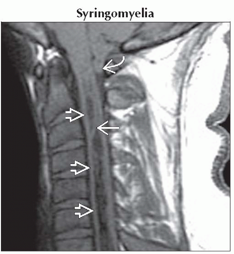 Intramedullary Lesions Multiple Neupsy Key