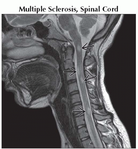 Intramedullary Lesions, Multiple | Neupsy Key