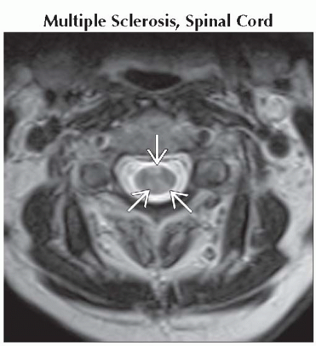 Intramedullary Lesions Multiple Neupsy Key