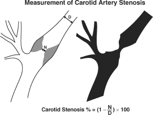 Carotid Artery Blockage Percentage Chart