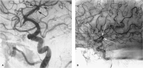 Intracranial Aneurysms Diagnosis And Treatment Neupsy Key 1532