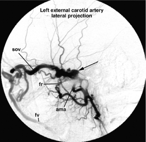 Cranial Dural Vascular Malformations | Neupsy Key