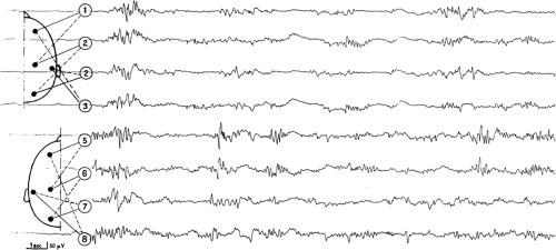 Benign Familial Neonatal Seizures And Benign Idiopathic Neonatal ...