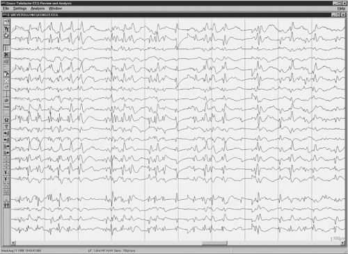 Psychiatric and Cognitive Phenomena as an Expression of Epileptic ...