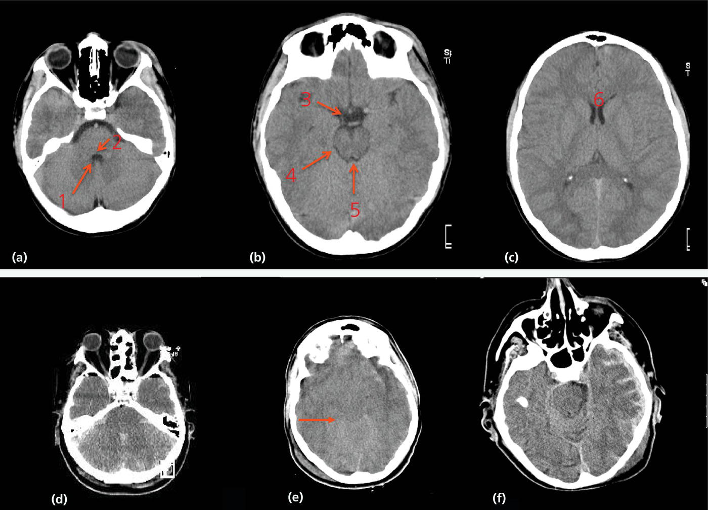 Traumatic Brain Injury CT Scan