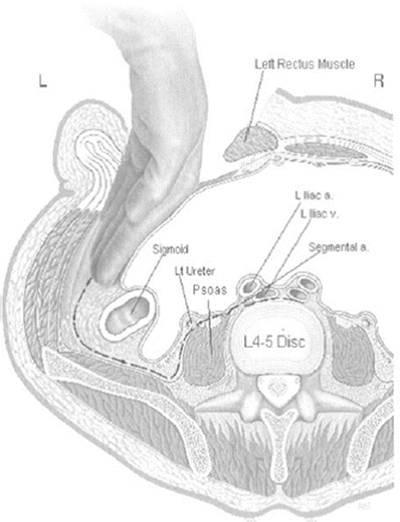 Anterior Retroperitoneal Muscle-Sparing Approach to L2–S1 of the Lumbar ...