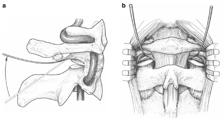 A11926_3_En_39_Fig4_HTML.gif