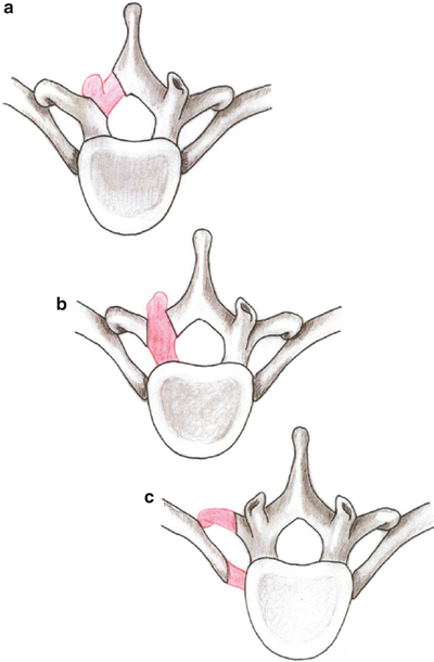 Posterior and Posterolateral Approaches to the Thoracic Disc | Neupsy Key