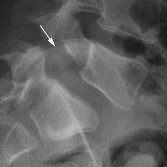 Spondylolisthesis | Neupsy Key