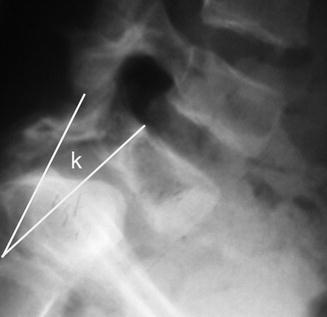 Spondylolisthesis | Neupsy Key