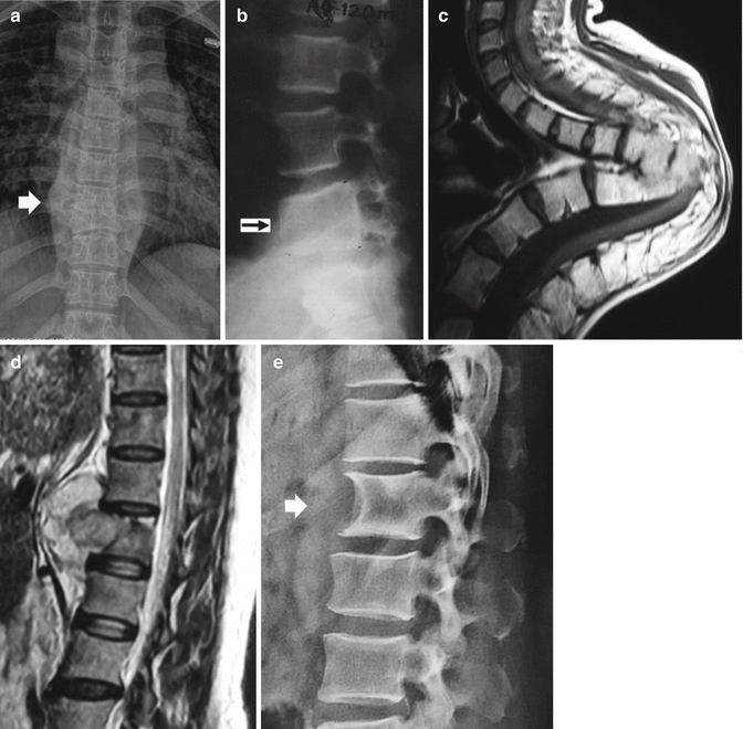 Pediatric Spinal Infections (Chronic) | Neupsy Key