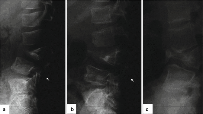 Pediatric Spinal Infections (Chronic) | Neupsy Key