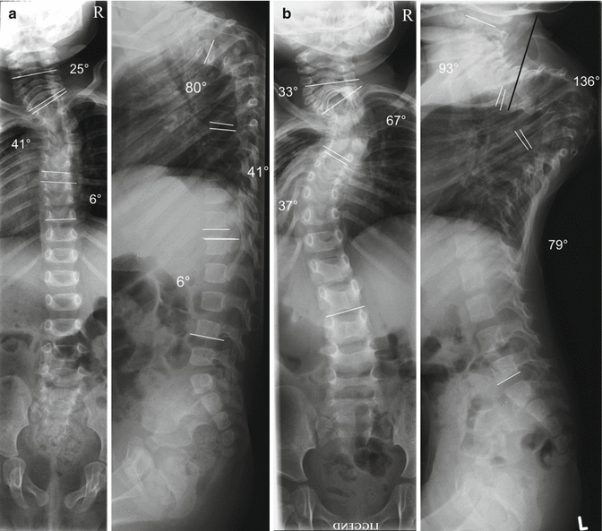 Vertebral Resection | Neupsy Key