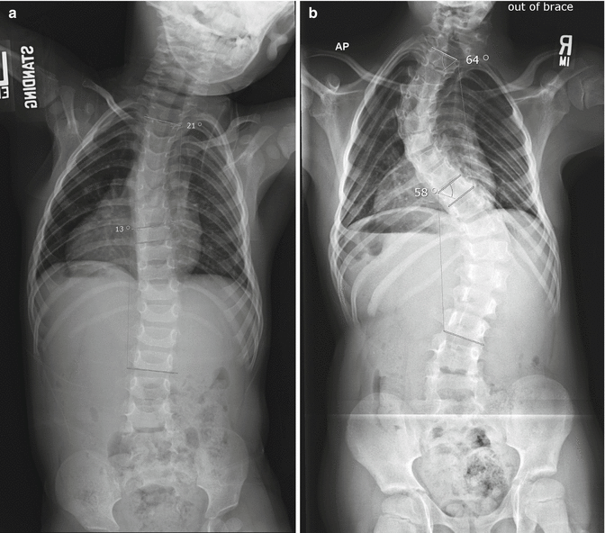 Apical Control in the Management of Severe Early-Onset Scoliosis ...