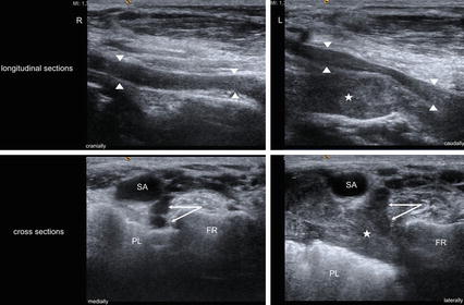 Nerve Entrapment at Shoulder and Arm | Neupsy Key