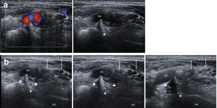 Nerve Entrapment at Shoulder and Arm | Neupsy Key