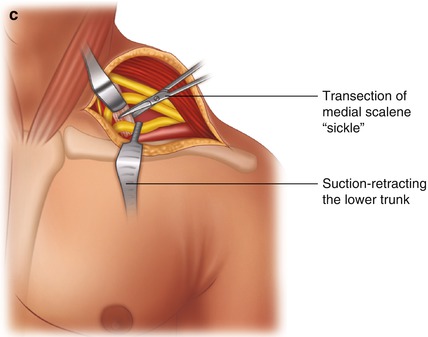 Nerve Entrapment At Shoulder And Arm Neupsy Key