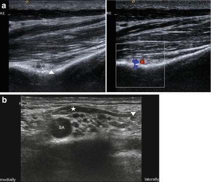 Nerve Entrapment at Shoulder and Arm | Neupsy Key