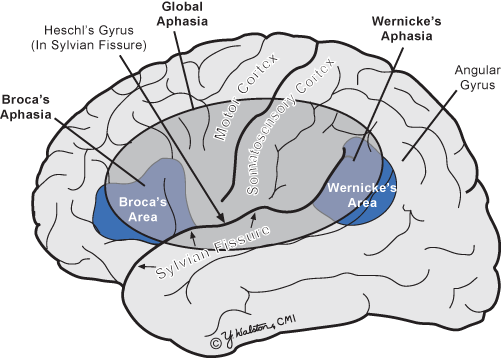 Шкловский афазия