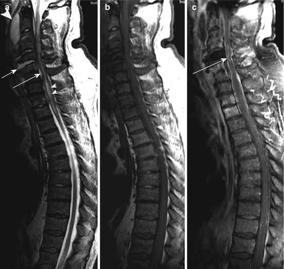 Diseases of Extramedullary Origin: Degenerative Diseases | Neupsy Key