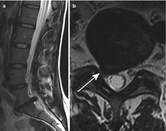 Diseases Of Extramedullary Origin: Degenerative Diseases | Neupsy Key