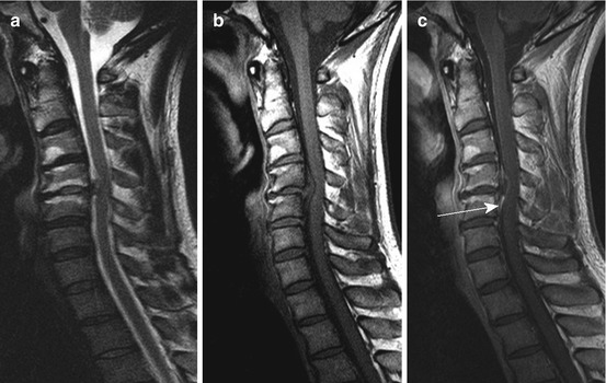 Diseases Of Extramedullary Origin: Degenerative Diseases | Neupsy Key