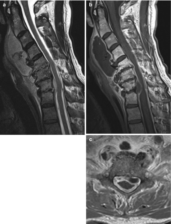 Meningeal Disorders | Neupsy Key