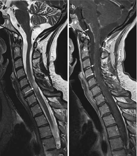 Meningeal Disorders | Neupsy Key