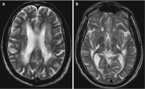 Metabolic-Toxic Diseases And Atrophic Changes Of The Spinal Cord ...