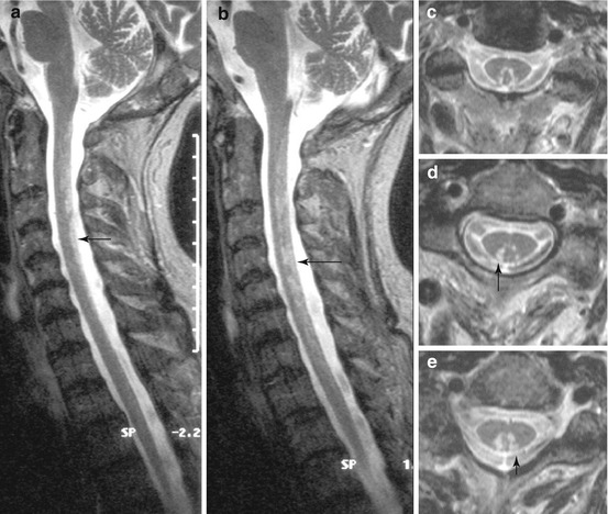 Metabolic-Toxic Diseases and Atrophic Changes of the Spinal Cord ...