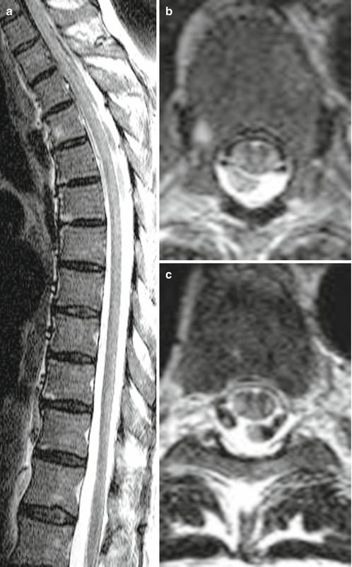 Metabolic-Toxic Diseases And Atrophic Changes Of The Spinal Cord ...