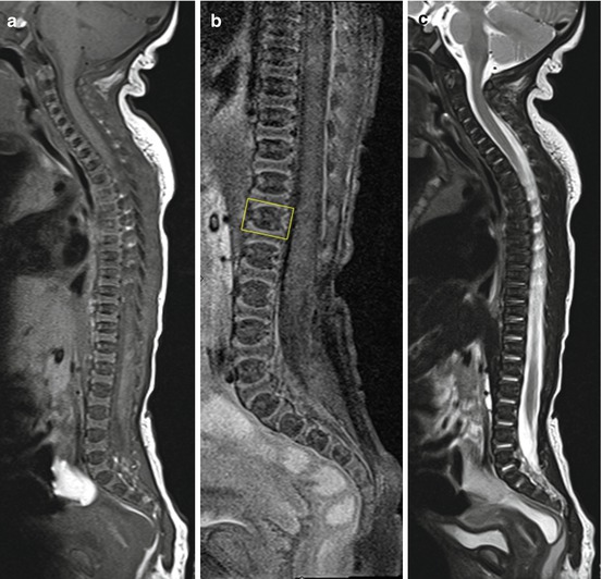 Anatomy of the Spine and Spinal Cord | Neupsy Key