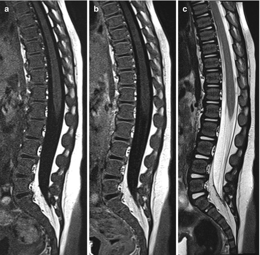 Anatomy of the Spine and Spinal Cord | Neupsy Key