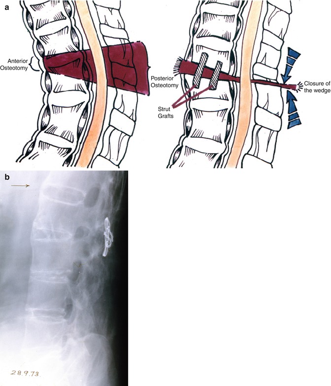 History Of Spinal Osteotomy For Thoracolumbar Kyphosis In Ankylosing Spondylitis Neupsy Key