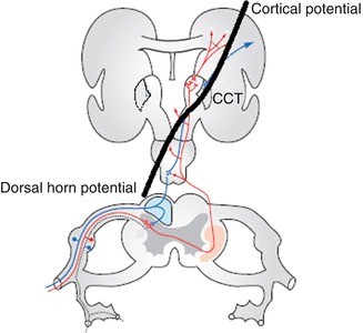 postsynaptic dorsal column spinal cord stimulation