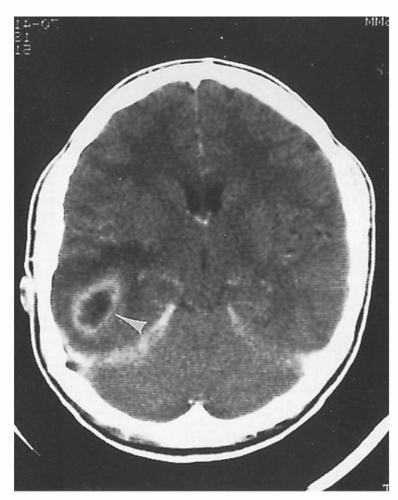 Central Nervous System Infections | Neupsy Key