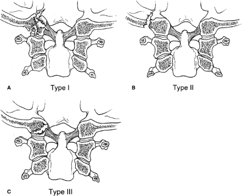 Types Occipital Condyle Skull Fractures Injuries Spine Montesano 