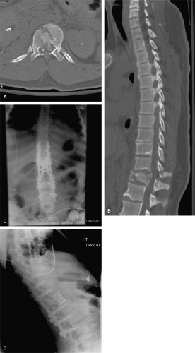 Postoperative Spinal Imaging | Neupsy Key