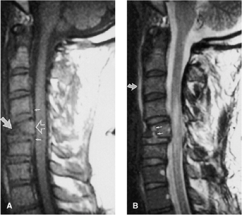 Magnetic Resonance Imaging of Acute Spinal Trauma | Neupsy Key