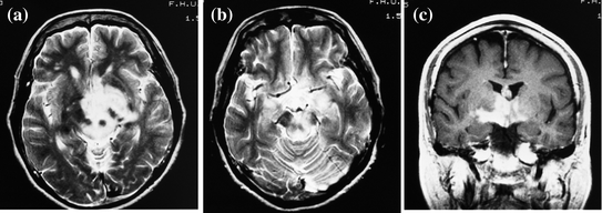 a brain scan of narcolepsy cataplexy