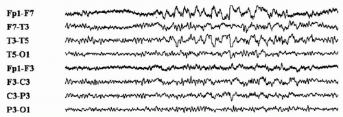 Application of Electroencephalography in the Diagnosis of Epilepsy ...