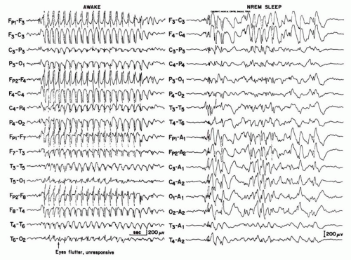absence seizure without eeg changes