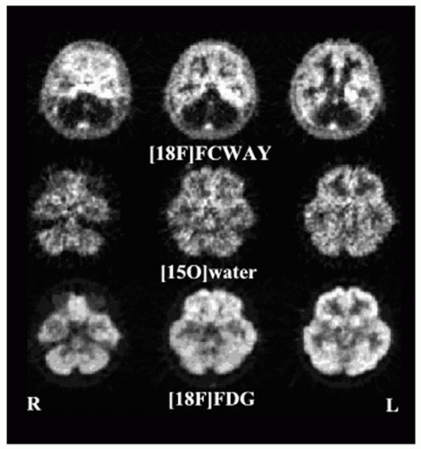 Metabolic And Functional Neuroimaging | Neupsy Key