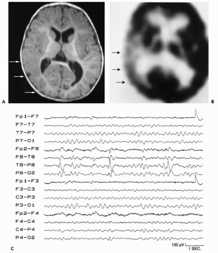 Epilepsy Surgery in Infants and Children | Neupsy Key