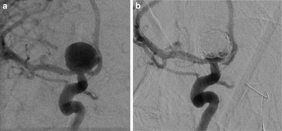 Unruptured Intracranial Aneurysms | Neupsy Key