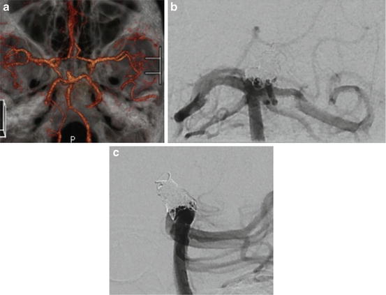 Unruptured Intracranial Aneurysms | Neupsy Key